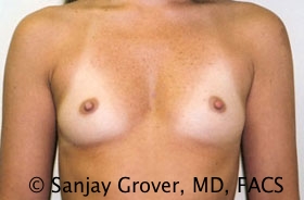 Breast Augmentation Before and After 134 | Sanjay Grover MD FACS