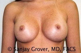 Breast Augmentation Before and After | Grover Aesthetics