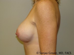 Breast Augmentation Before and After 171 | Grover Aesthetics