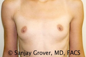 Breast Augmentation Before and After | Grover Aesthetics
