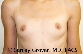 Breast Augmentation Before and After 254 | Sanjay Grover MD FACS