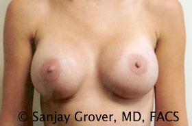 Breast Augmentation Before and After | Grover Aesthetics
