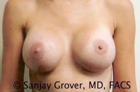 Breast Augmentation Before and After 172 | Sanjay Grover MD FACS