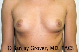 Breast Augmentation Before and After 75 | Sanjay Grover MD FACS