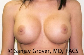 Breast Augmentation Before and After 173 | Sanjay Grover MD FACS