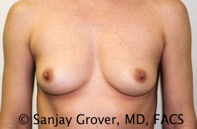 Breast Augmentation Before and After 79 | Sanjay Grover MD FACS