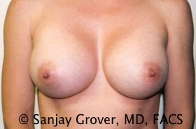 Breast Augmentation Before and After | Sanjay Grover MD FACS