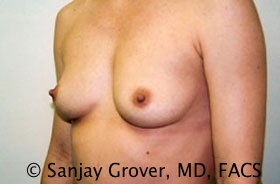 Breast Augmentation Before and After 174 | Grover Aesthetics