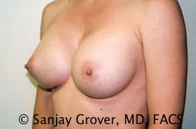 Breast Augmentation Before and After 174 | Grover Aesthetics
