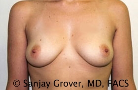 Breast Augmentation Before and After 47 | Sanjay Grover MD FACS