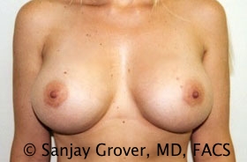 Breast Augmentation Before and After | Grover Aesthetics