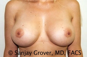 Breast Augmentation Before and After 175 | Sanjay Grover MD FACS