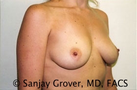 Breast Augmentation Before and After 175 | Grover Aesthetics