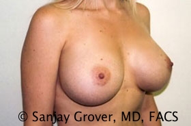 Breast Augmentation Before and After 175 | Grover Aesthetics