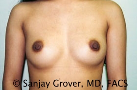 Breast Augmentation Before and After | Grover Aesthetics
