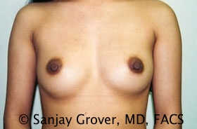 Breast Augmentation Before and After 189 | Sanjay Grover MD FACS