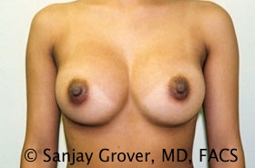Breast Augmentation Before and After | Grover Aesthetics