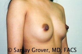 Breast Augmentation Before and After 176 | Grover Aesthetics