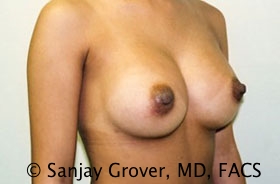 Breast Augmentation Before and After 176 | Grover Aesthetics