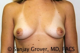 Breast Augmentation Before and After | Grover Aesthetics