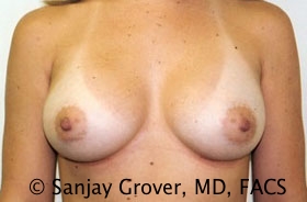 Breast Augmentation Before and After | Sanjay Grover MD FACS