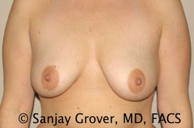 Breast Augmentation Before and After | Grover Aesthetics