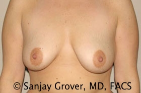 Breast Augmentation Before and After 241 | Sanjay Grover MD FACS