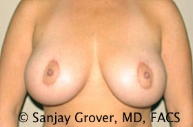 Breast Augmentation Before and After | Grover Aesthetics