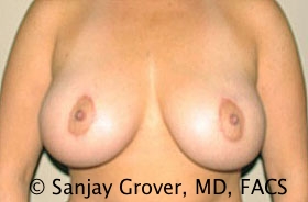 Breast Augmentation Before and After 178 | Sanjay Grover MD FACS