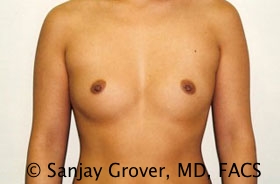 Breast Augmentation Before and After | Grover Aesthetics