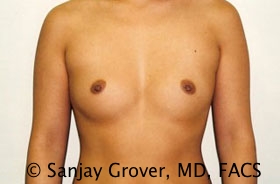 Breast Augmentation Before and After 189 | Sanjay Grover MD FACS