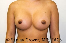 Breast Augmentation Before and After | Grover Aesthetics