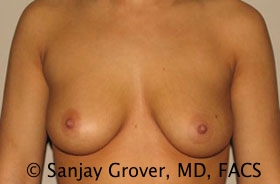 Breast Augmentation Before and After 143 | Sanjay Grover MD FACS