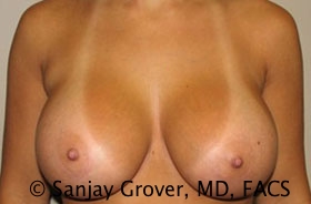 Breast Augmentation Before and After | Grover Aesthetics
