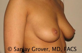 Breast Augmentation Before and After 18 | Grover Aesthetics
