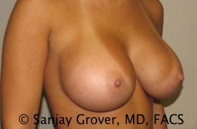 Breast Augmentation Before and After 18 | Sanjay Grover MD FACS