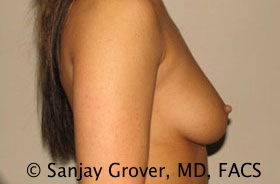 Breast Augmentation Before and After 18 | Grover Aesthetics