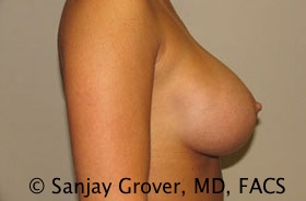Breast Augmentation Before and After 18 | Grover Aesthetics