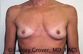 Breast Augmentation Before and After | Grover Aesthetics
