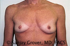 Breast Augmentation Before and After 48 | Sanjay Grover MD FACS