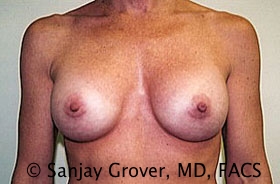 Breast Augmentation Before and After | Sanjay Grover MD FACS