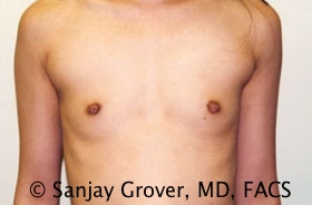 Breast Augmentation Before and After | Grover Aesthetics