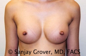 Breast Augmentation Before and After | Grover Aesthetics