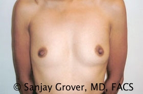 Breast Augmentation Before and After | Grover Aesthetics