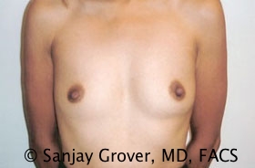 Breast Augmentation Before and After 99 | Sanjay Grover MD FACS