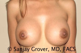 Breast Augmentation Before and After | Grover Aesthetics