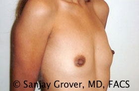 Breast Augmentation Before and After 182 | Grover Aesthetics