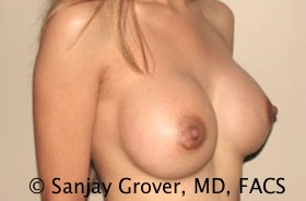 Breast Augmentation Before and After 182 | Grover Aesthetics