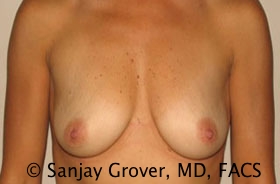 Breast Augmentation Before and After 53 | Sanjay Grover MD FACS