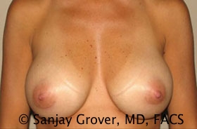 Breast Augmentation Before and After | Grover Aesthetics